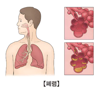 폐렴