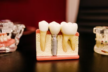 임플란트 시술과정 시술기간 시술 종류