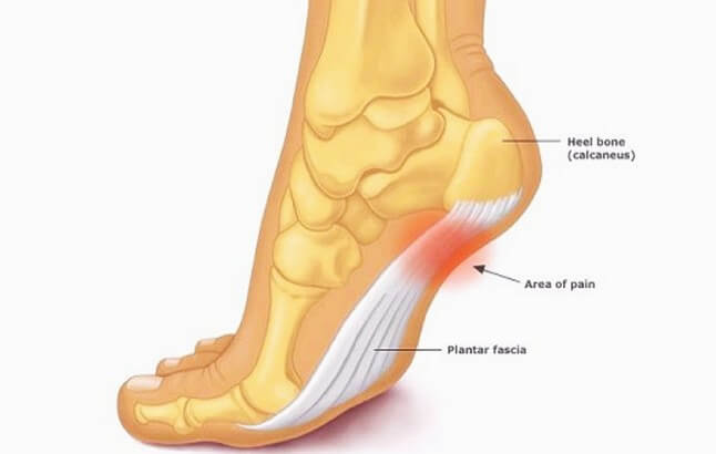 족저 근막염 발생 이유 설명