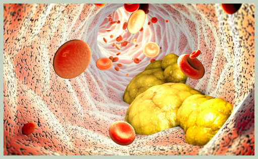 중성지방 낮추는 방법