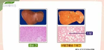 비알콜성 지방간 없애는 방법 운동 식단 중심 회복법 정리_6