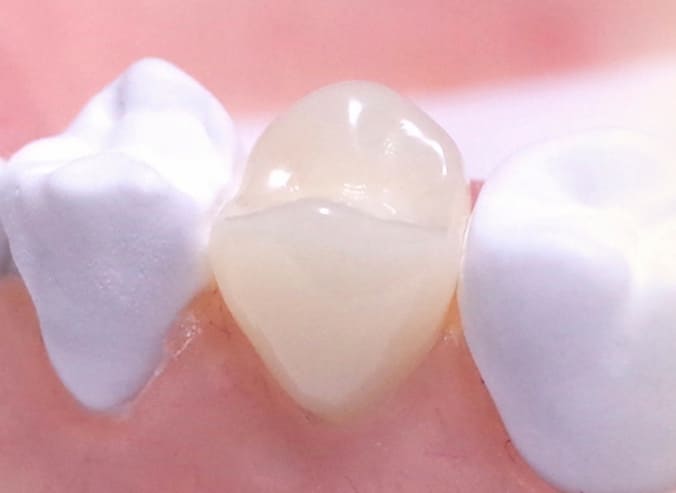 치아보험-추천-후기와-2년-면책기간-특징-알아보기-저렴하고-좋은-플랜-선택-가이드