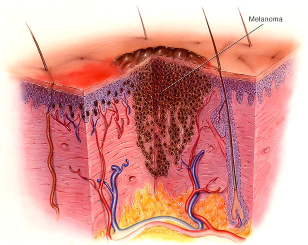 흑색종 증상 피부암 초기 및 치료법과 예후 총정리