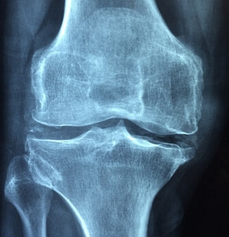 관절염 초기 환자의 엑스레이 사진