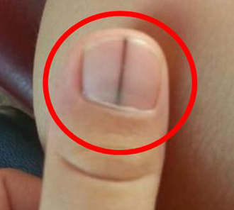 손톱 검은세로줄 원인 6가지 이유 흑색종 당뇨 어느 병원 없애는 방법