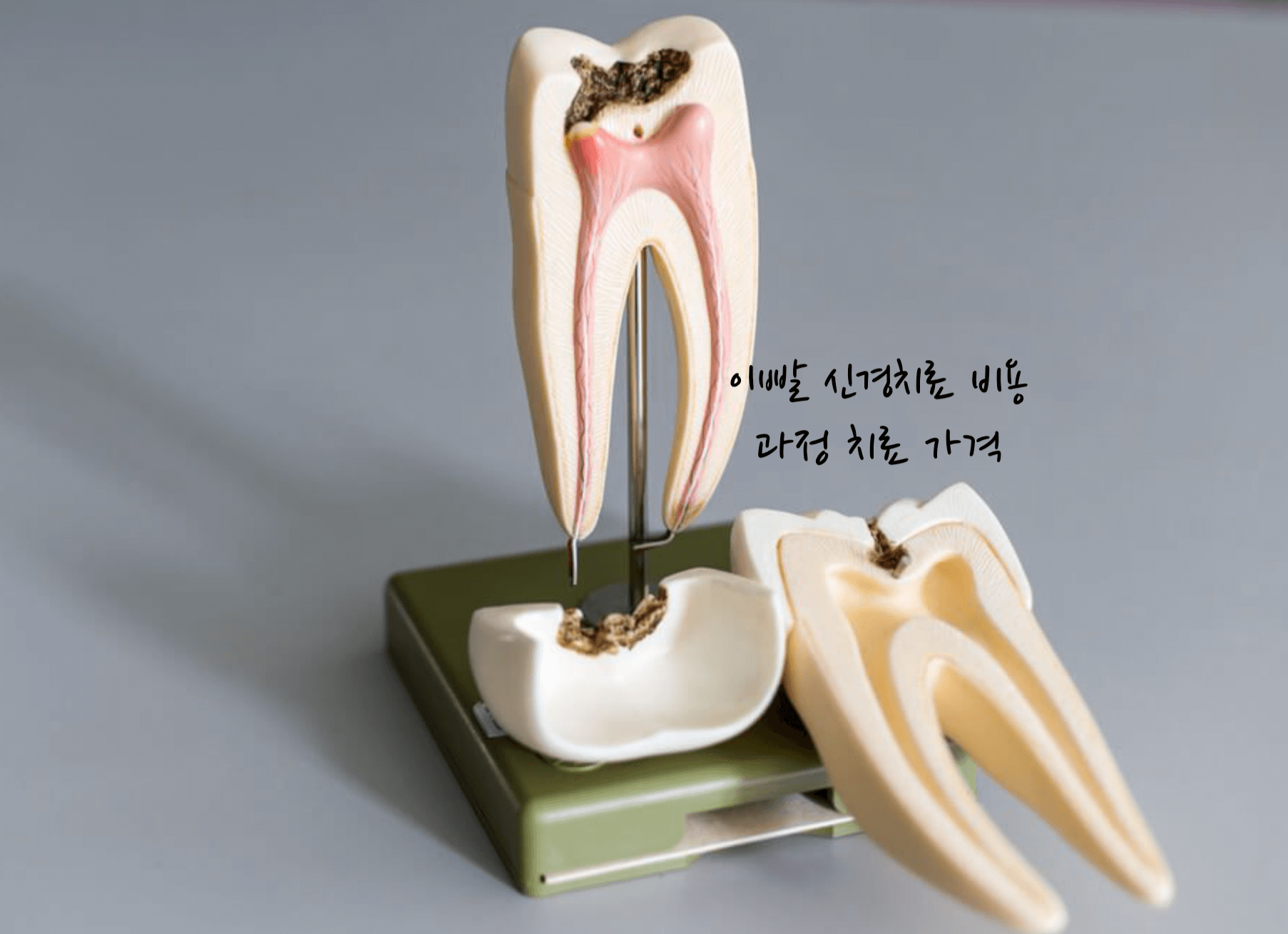 이빨 신경치료 비용