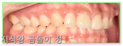 라미네이트 란? 앞니 벌어짐 해결 빠른 치료와 관리법 정리4