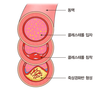 고지혈증