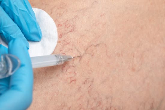 모세혈관 확장증 원인과 치료법, 피부과에서 알아두어야 할 모든 것