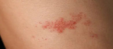 대상포진 예방접종 가격