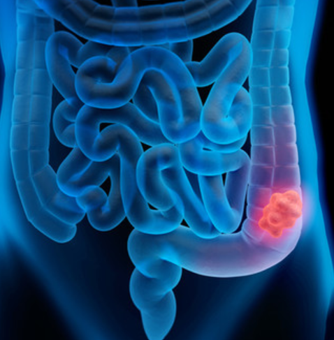 꼭 받아야 할 주요 암검진 항목 대장내시경 검사