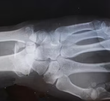 류마티스 관절염 초기증상 치료 원인 예방법