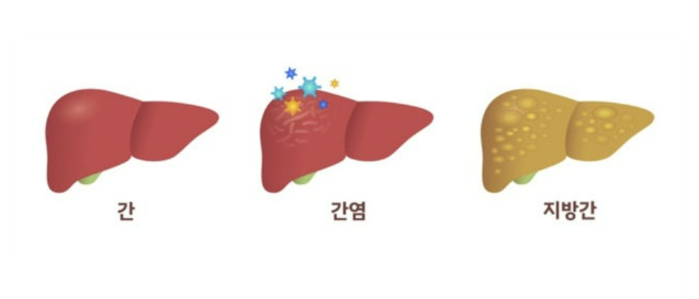 간염