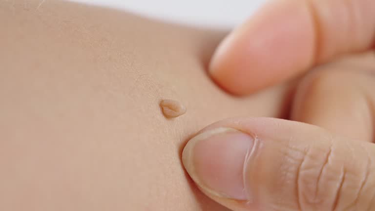 왜 쥐젖이 생길까? 쥐젖 원인부터 제거 방법까지 한눈에 보기!