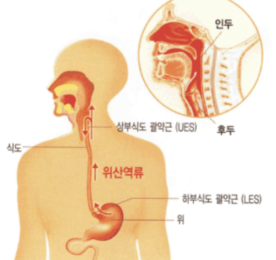 역류성후두염치료법