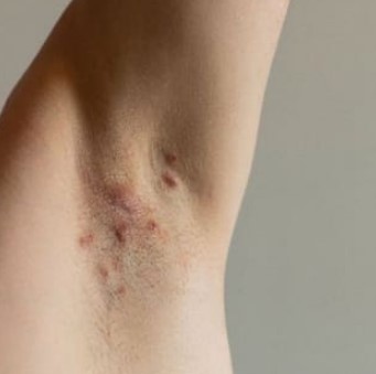 화농성 한선염 원인 증상 및 화농성 한선염 치료 방법 5가지