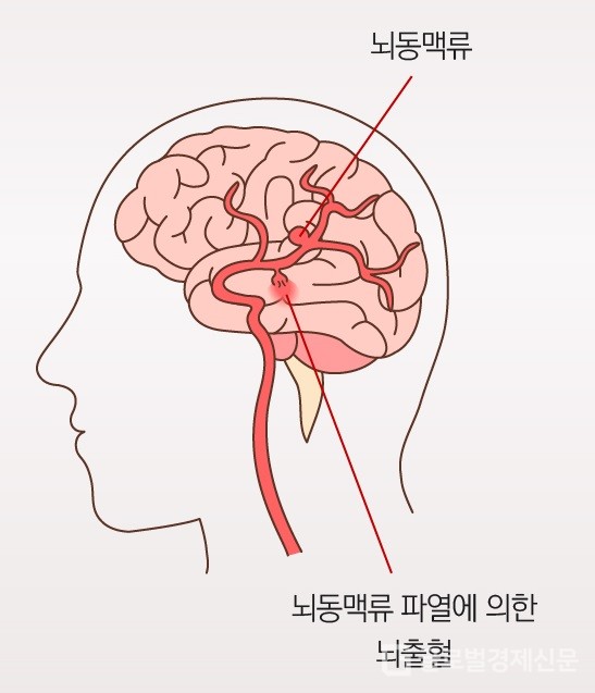 뇌동맥류 증상