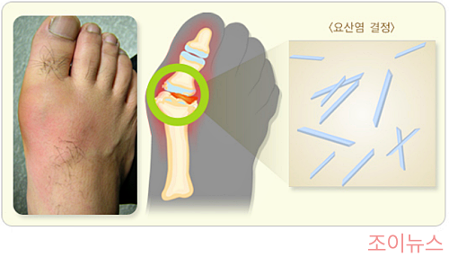 급성 통풍 발작_출처:질병관리청