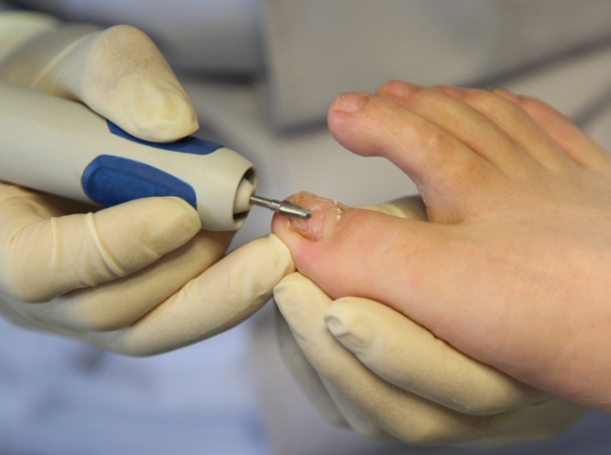 발톱을 치료중인 장면