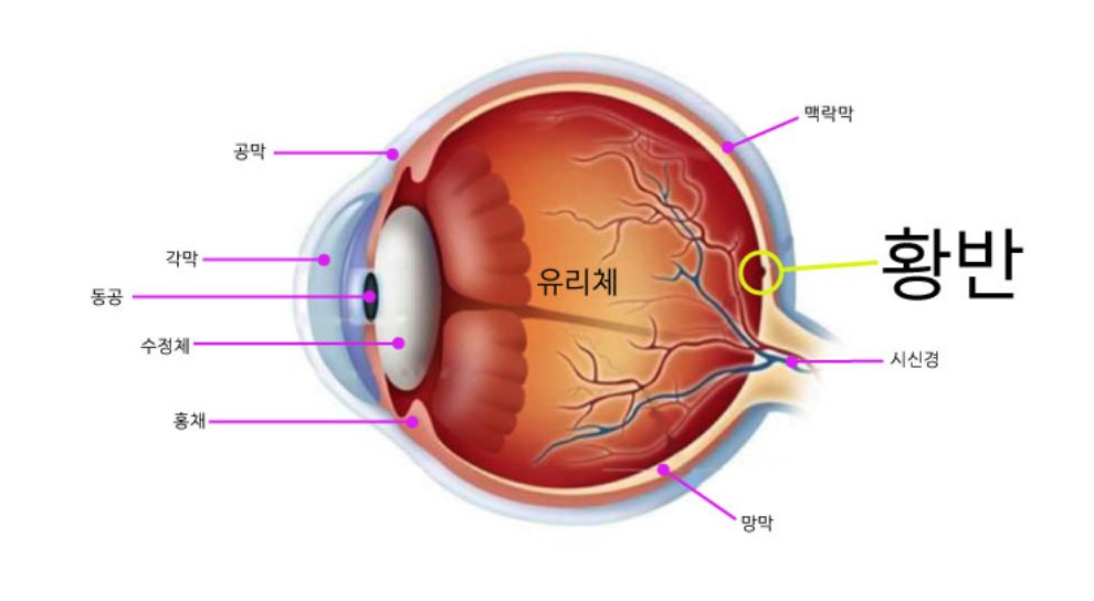 황반변성 증상