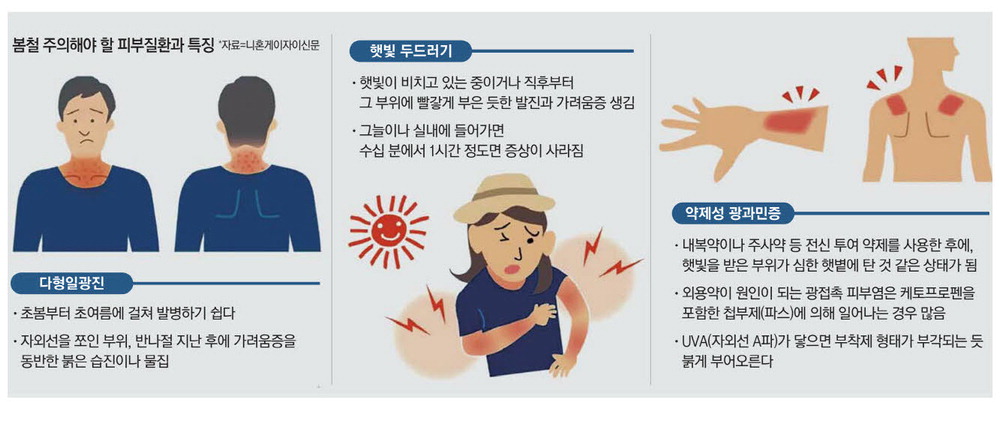 햇빛 알레르기(광과민성 피부질환) 절망적인 삶 관련 이미지