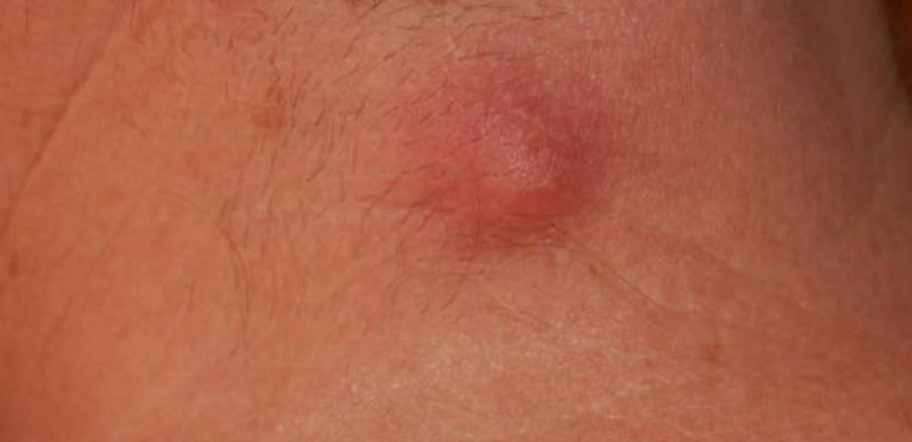 남자 사타구니 종기