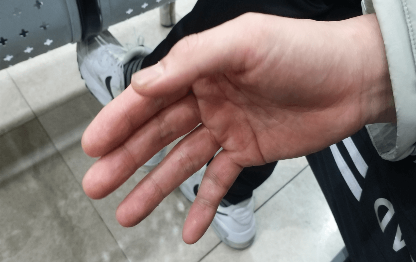 손가락인대파열실제사진