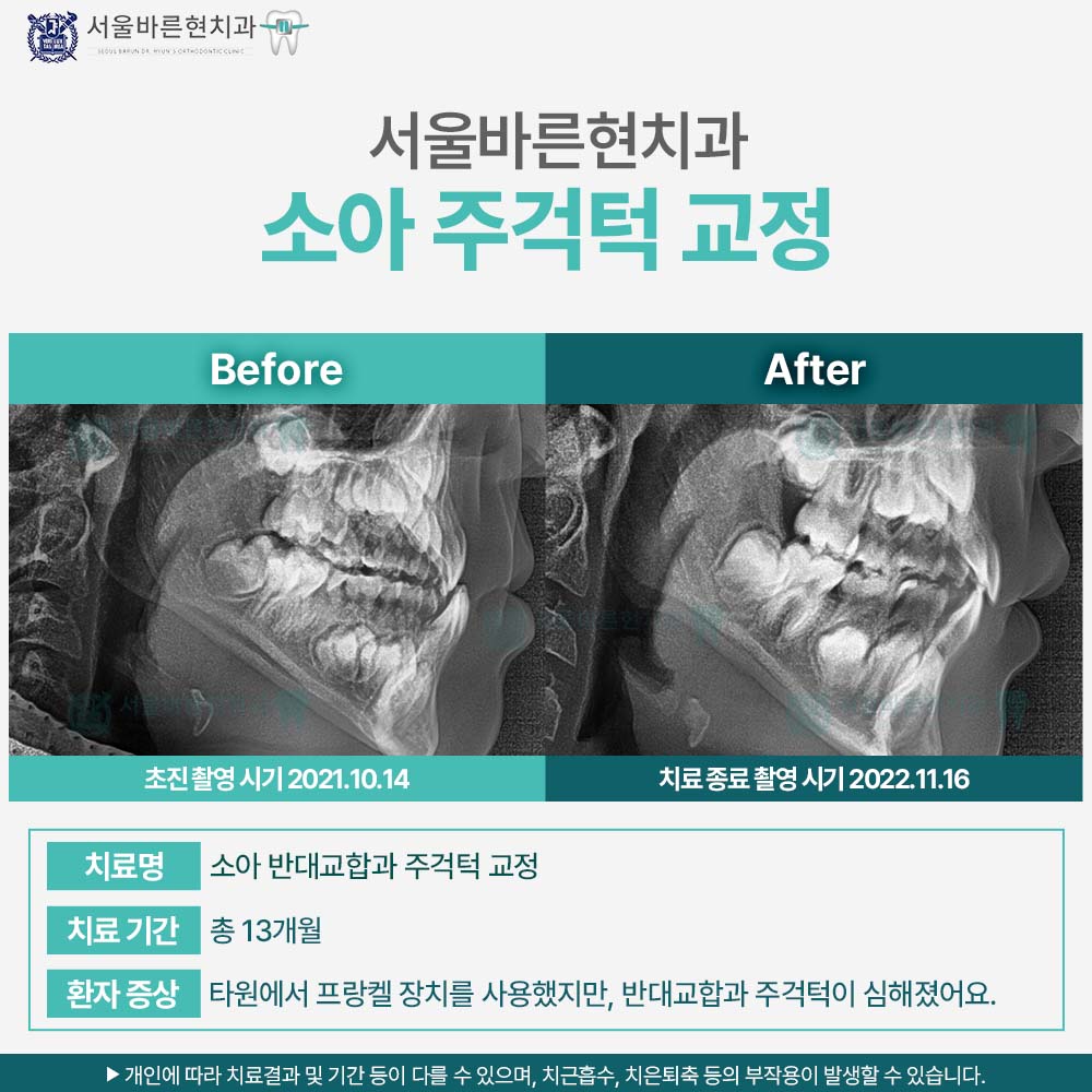 해운대치아교정