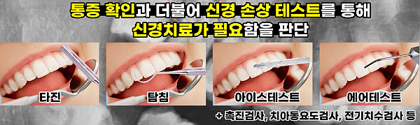 통증 확인, 신경치료결정여부