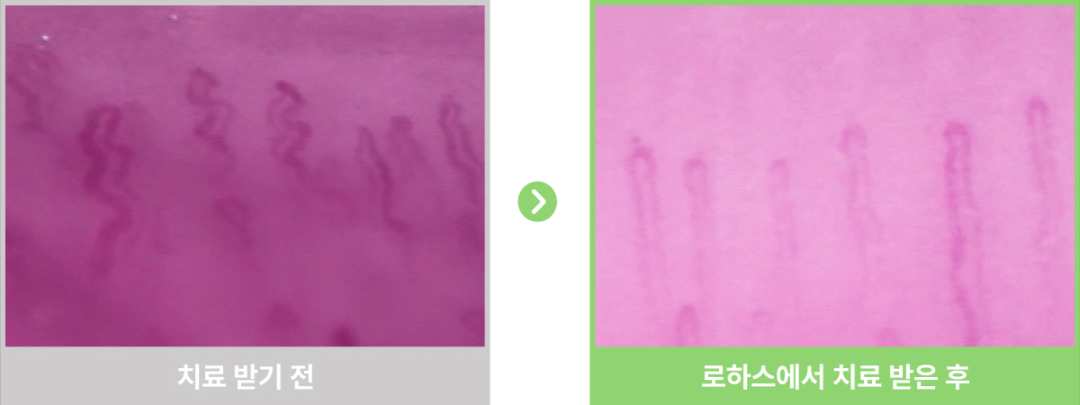 금진옥액 치료 전후 모세혈관 비교 사진