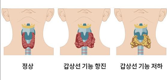 갑상선의 기능이상 관련 이미지