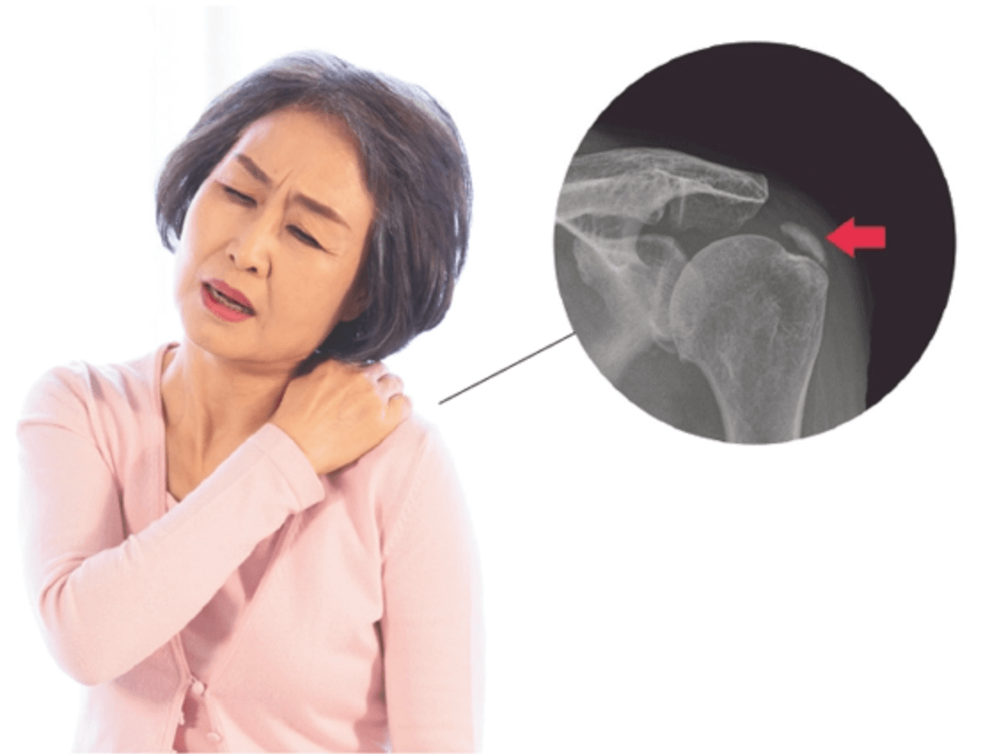 어깨 석회성 건염 증상