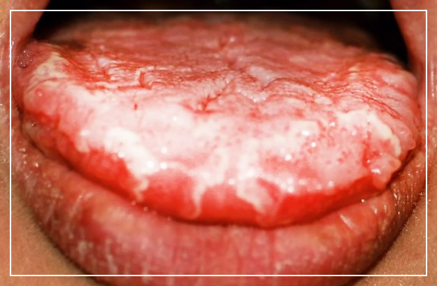 칸디다성구내염-사진