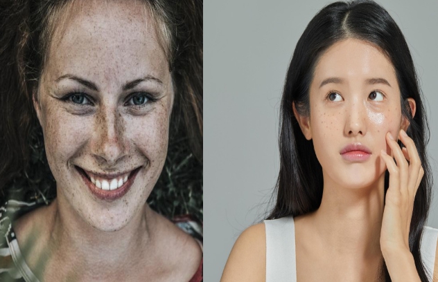 기미와 주근깨 차이