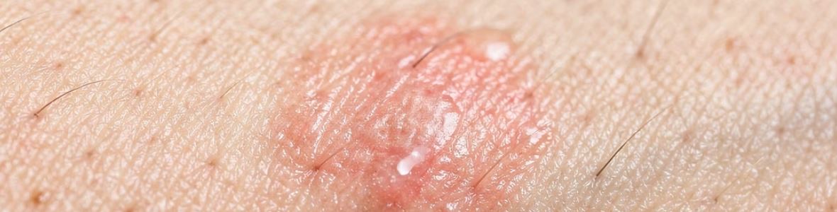 진드기 물린 후 증상