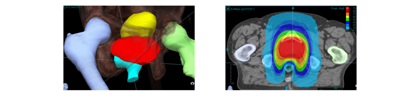 토모테라피 래디잭트 치료예