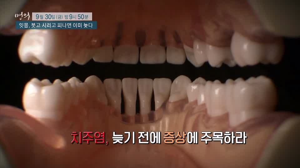 명의 붓고, 시리고, 피나면 이미 늦는 치주염 잇몸 질환 치주질환 치료, 예방 방법