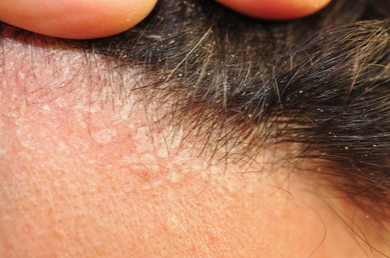 지루성피부염-원인과-치료방법