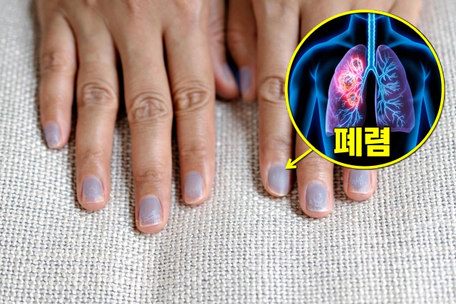 푸른색 손톱 폐렴 증상 청색증, 손톱으로 보는 건강상태, 건강 팁줌 매일꿀정보