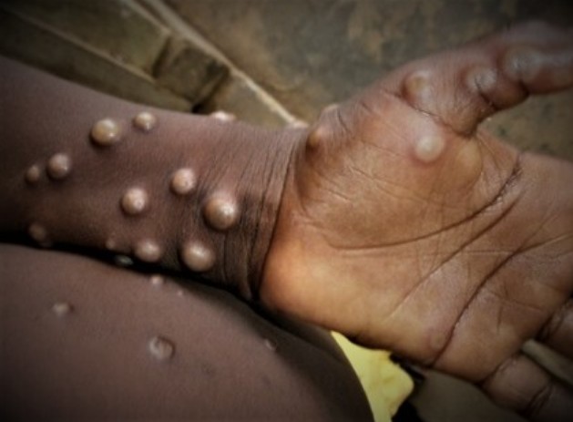 엠폭스 뜻 어떤 증상 및 원인 엠폭스 격리 및 예방접종