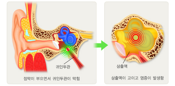 중이염 발생과정