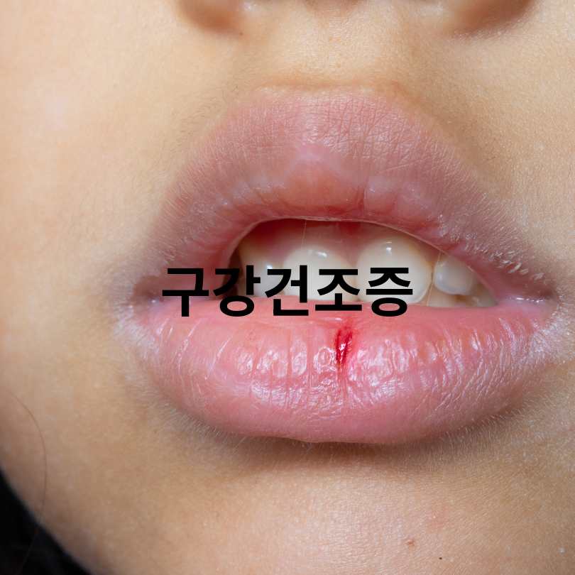 혀 갈라짐의 원인과 대처법