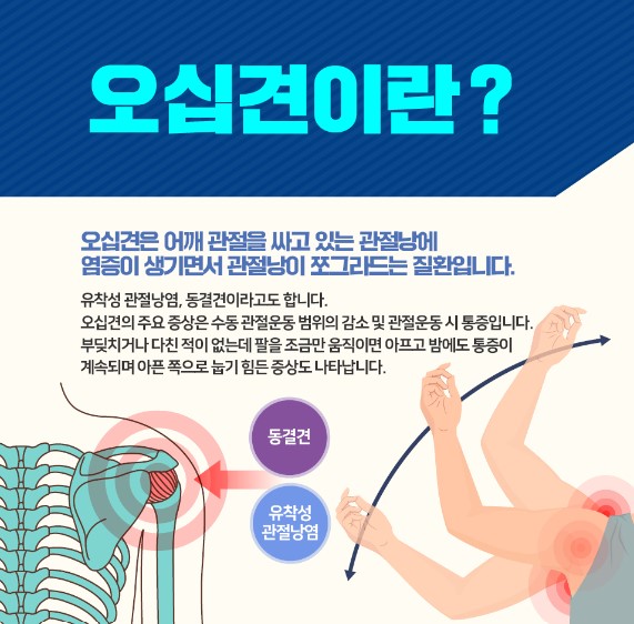 어깨통증-원인-오십견-회전근개-치료법