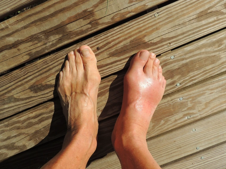 통풍에 걸린 발 사진