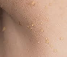 쥐젖 제거방법 2