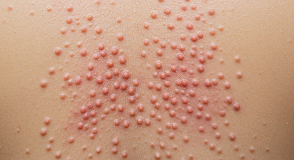 대상포진 초기증상