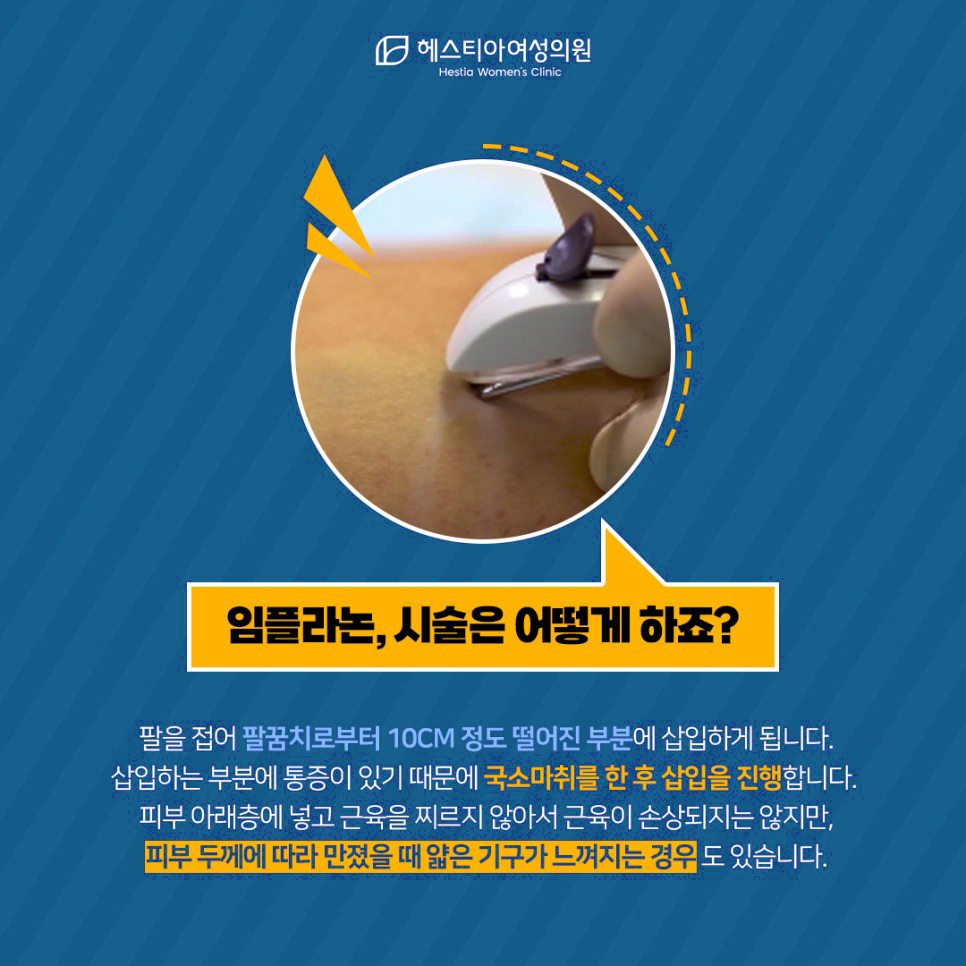 임플라논 시술방법