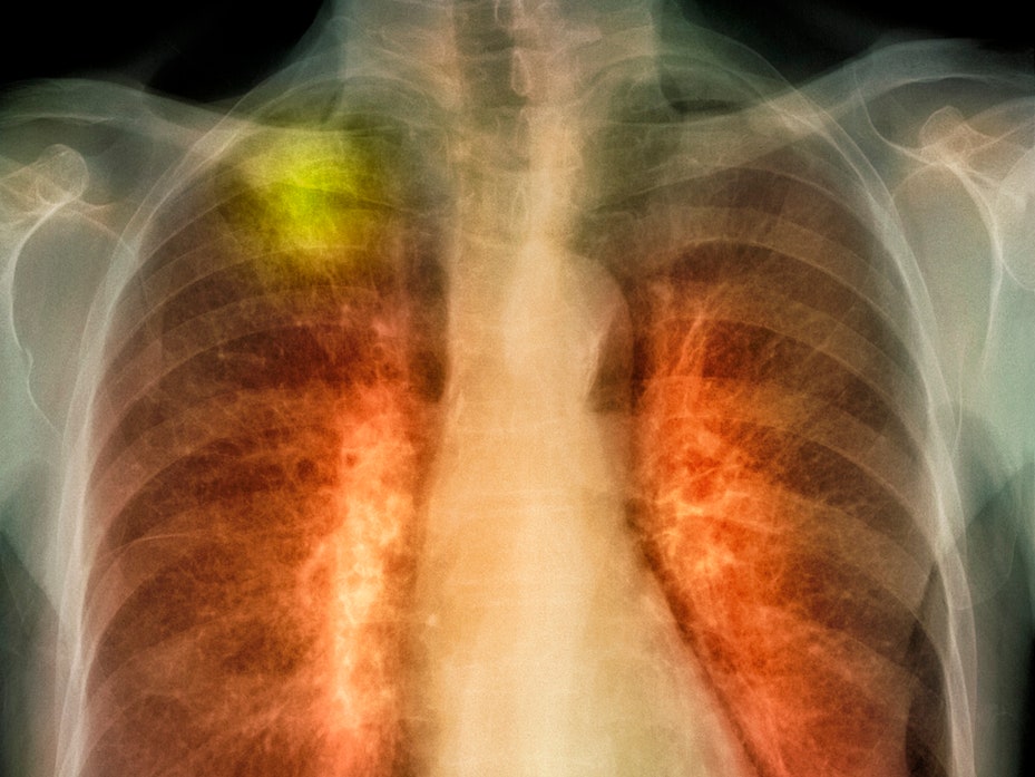 위내시경 금식시간