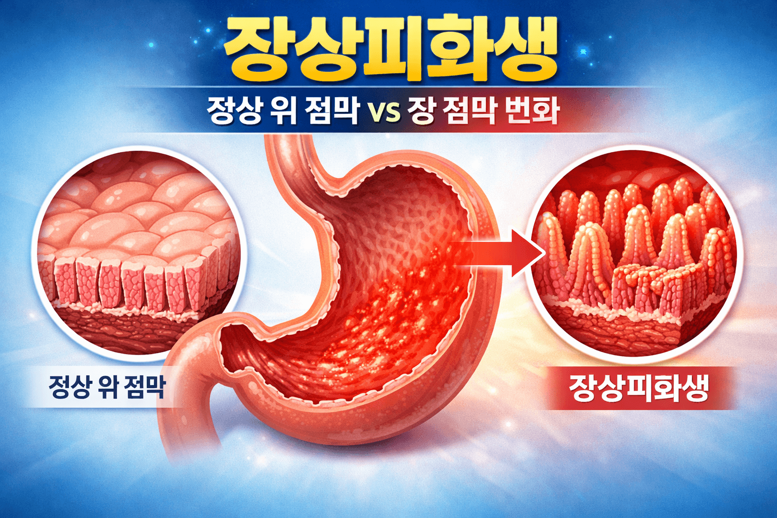 장상피화생 관리 (치유, 증상, 식단)