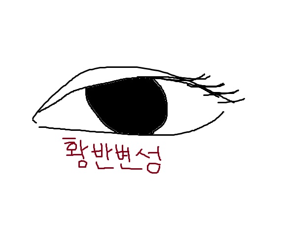 황반변성에 대한 그림